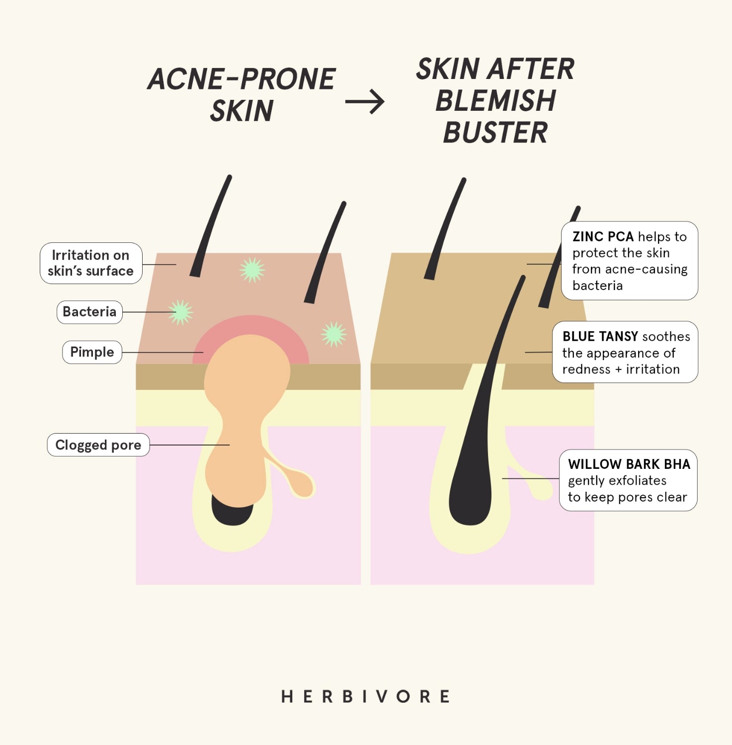 BLEMISH BUSTERS - 3-Steps to Clear Skin